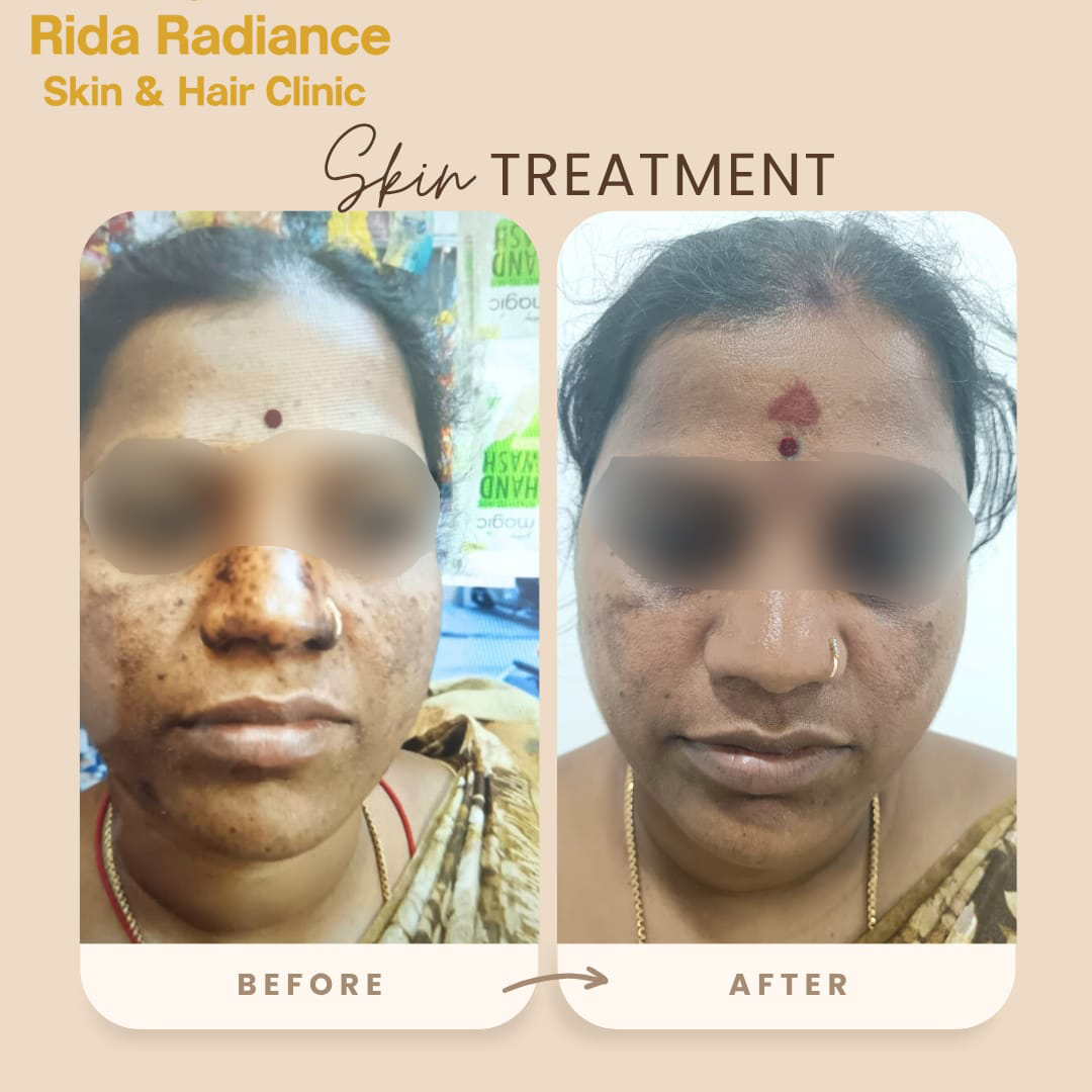 CO2 laser before and after